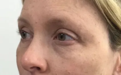 Unknown After Upper Blepharoplasty Three Quarters