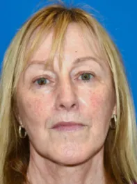 KY After Face and Neck Lift, Brow Lift