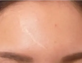 NAH White Scar Treatment Forehead Before