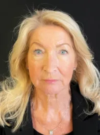 KY Before Deep Plane Face and Neck Lift, Brow Lift, Lip Lift, Bleph & Fat Transfer