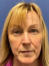 KY Before Face and Neck Lift, Brow Lift