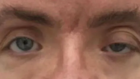 EH Before Male Upper Blepharoplasty