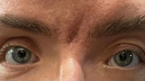 EH After Male Upper Blepharoplasty