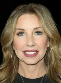 SC After Face and Neck Lift