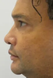 PT After Nose Tip Rhinoplasty Profile