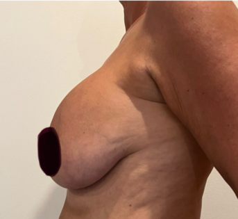 GG Before Mastopexy Side