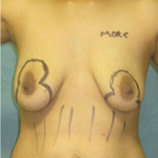 Fat Transfer Breast Before 1