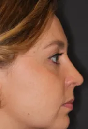 Unknown After Rhinoplasty
