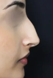 TJ Before Rhinoplasty Profile