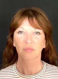 KY After Deep Plane Face and Neck Lift, Brow Lift, Lip Lift, Bleph & Fat Transfer