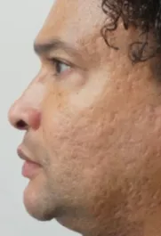 PT Before Nose Tip Rhinoplasty Profile