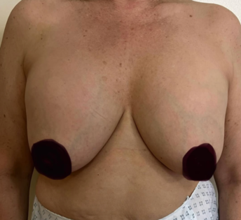 GG Before Mastopexy Front