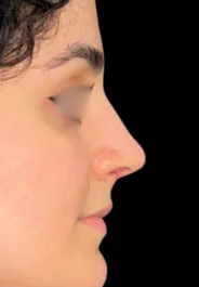 SP Septorhinoplasty After Side