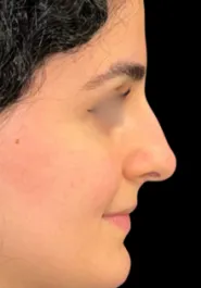 SP Septorhinoplasty Before Side
