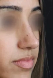 TJ After Septorhinoplasty Three Quater View