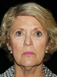 SC Before Face and Neck Lift