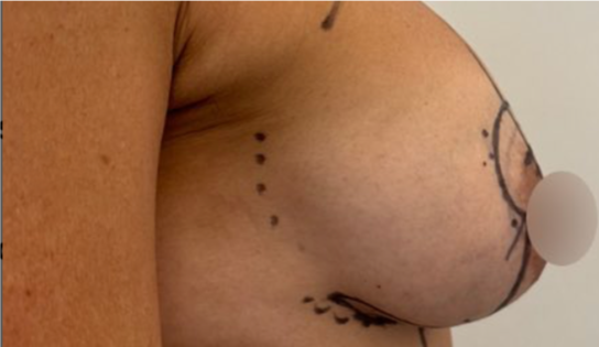 WVN Before Mastopexy & Implant Exchange Side