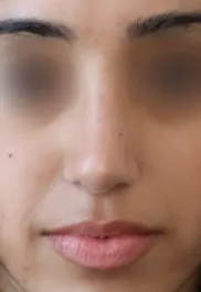 TJ After Septorhinoplasty Front