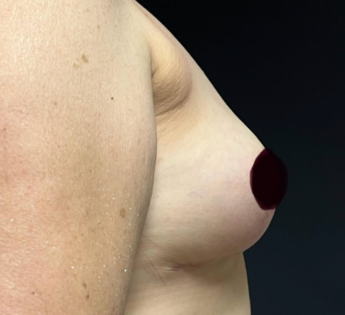 GG After Mastopexy Side