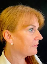 KY Before Deep Plane Face and Neck Lift, Brow Lift, Bleph & Fat Transfer