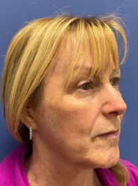 KY Before Face and Neck Lift, Brow Lift