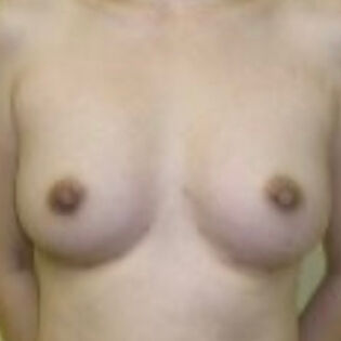 Fat Transfer Breast After 4