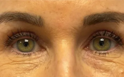 EH After Upper Blepharoplasty