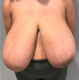SSJ Breast Reduction Before Front
