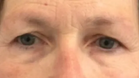 EH Before Upper Blepharoplasty