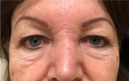 GG Before Upper and Lower Blepharoplasty