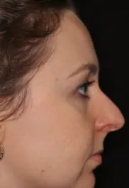 Unknown Before Rhinoplasty