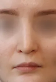 TJ After Septorhinoplasty Front