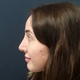 Unknown After Rhinoplasty