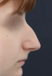 TJ Before Rhinoplasty Profile