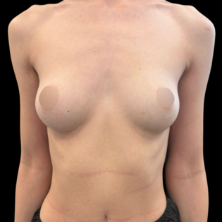 Cadogan Clinic RS Breast Augmentation Before