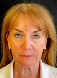 KY Before Deep Plane Face and Neck Lift, Brow Lift, Bleph & Fat Transfer