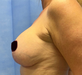 GG After Mastopexy Side