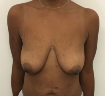 Unknown Before Mastopexy