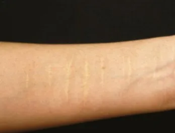 NAH White Scar Treatment Arm Before
