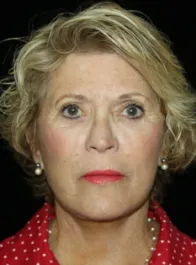 SC After Face and Neck Lift
