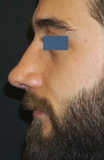 TT After Nose Tip Rhinoplasty
