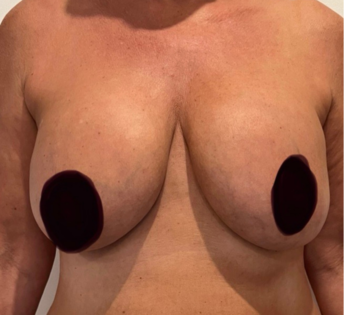 GG Before Mastopexy Front