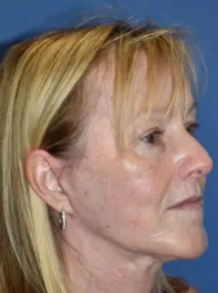KY After Face and Neck Lift, Brow Lift