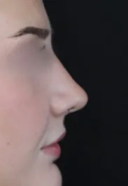 TJ Rhinoplasty After Side