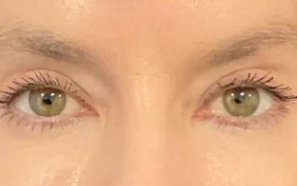 KY After Upper Blepharoplasty Front