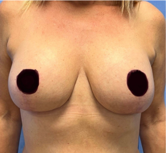 GG After Mastopexy Front