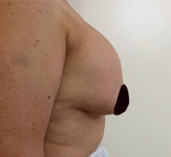 GG Before Mastopexy Side