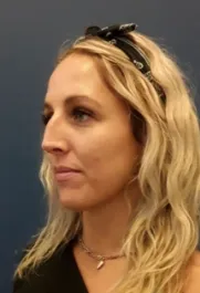 Unknown Before Rhinoplasty