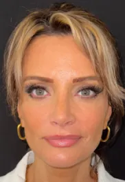 SP Septorhinoplasty After Front