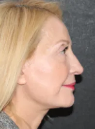 TT After Face and Neck Lift, Bleph and Fat Transfer
